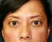 Feel Beautiful - Radiesse filler in lower eyelids - After Photo
